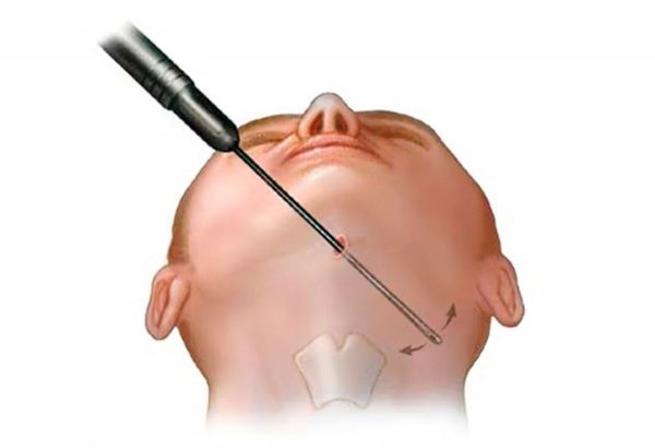  اگر بعد از ساکشن غبغب ماساژ ندیم چی میشه+آیا ساکشن غبغب درد دارد+آیا ساکشن غبغب نیاز به بیهوشی دارد+آیا غبغب با ورزش از بین می‌رود
