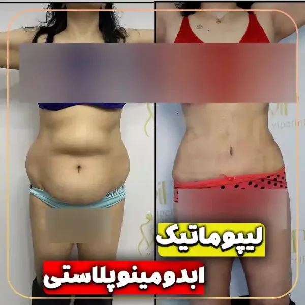 عکس قبل و بعد عمل لیپو ابدو+عکس لیفت شکم بدون جراحی+هزینه برداشتن چربی شکم بدون جراحی+فیلم دستگاه لاغری شکم