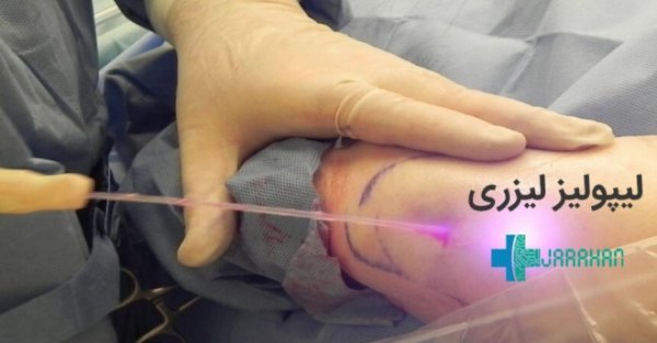  عکس قبل و بعد عمل لیپو ابدو+عکس لیفت شکم بدون جراحی+هزینه برداشتن چربی شکم بدون جراحی+فیلم دستگاه لاغری شکم