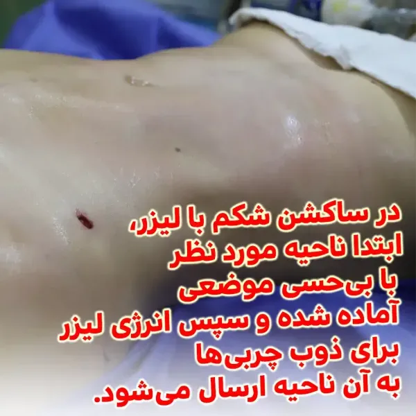  عکس قبل و بعد عمل لیپو ابدو+عکس لیفت شکم بدون جراحی+هزینه برداشتن چربی شکم بدون جراحی+فیلم دستگاه لاغری شکم