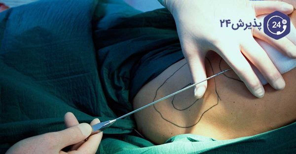  عکس قبل و بعد عمل لیپو ابدو+عکس لیفت شکم بدون جراحی+هزینه برداشتن چربی شکم بدون جراحی+فیلم دستگاه لاغری شکم