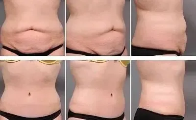  عکس قبل و بعد عمل لیپو ابدو+عکس لیفت شکم بدون جراحی+هزینه برداشتن چربی شکم بدون جراحی+فیلم دستگاه لاغری شکم