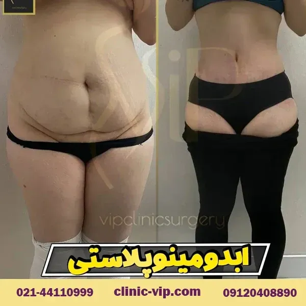  عکس قبل و بعد عمل لیپو ابدو+عکس لیفت شکم بدون جراحی+هزینه برداشتن چربی شکم بدون جراحی+فیلم دستگاه لاغری شکم