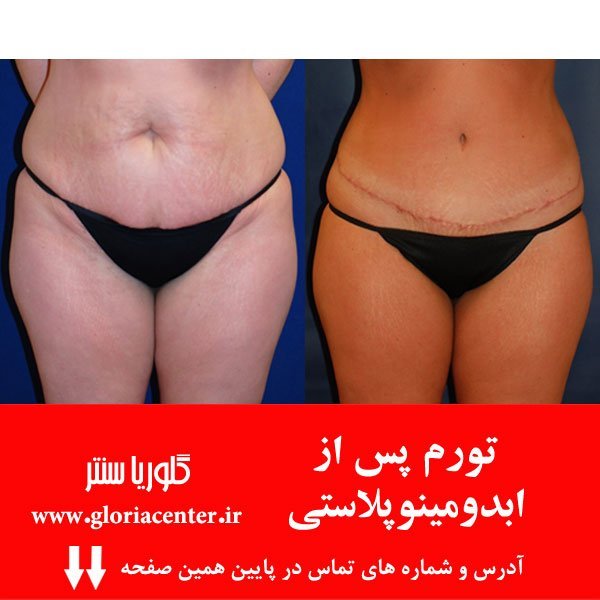  چقدر قبل از عمل نباید سیگار کشید+بعد از عمل ابدو چه لباسی بپوشیم+چرا بعد عمل ابدو شکم ورم دارد+چه مدت بعد از ابدو میتوان سکس داشت