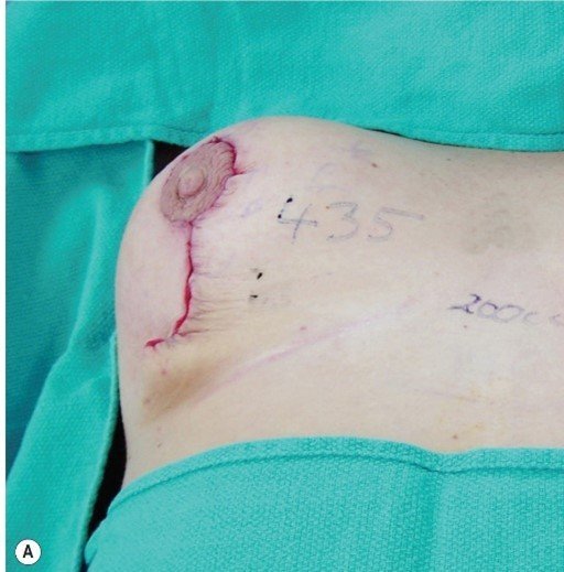  عمل ماموپلاستی چقدر طول میکشد+آیا بعدماموپلاستی می‌توان رابطه داشت+ماموپلاستی با بیمه تکمیلی انجام می‌شود+ماموپلاستی و شیردهی