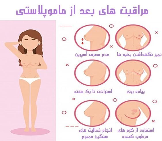  عمل ماموپلاستی چقدر طول میکشد+آیا بعدماموپلاستی می‌توان رابطه داشت+ماموپلاستی با بیمه تکمیلی انجام می‌شود+ماموپلاستی و شیردهی