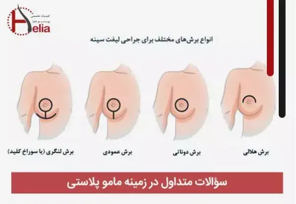  عمل ماموپلاستی چقدر طول میکشد+آیا بعدماموپلاستی می‌توان رابطه داشت+ماموپلاستی با بیمه تکمیلی انجام می‌شود+ماموپلاستی و شیردهی