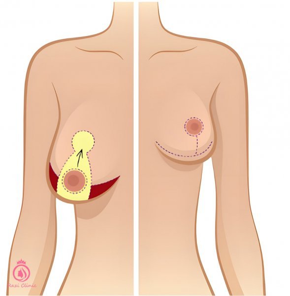  عمل ماموپلاستی چقدر طول میکشد+آیا بعدماموپلاستی می‌توان رابطه داشت+ماموپلاستی با بیمه تکمیلی انجام می‌شود+ماموپلاستی و شیردهی