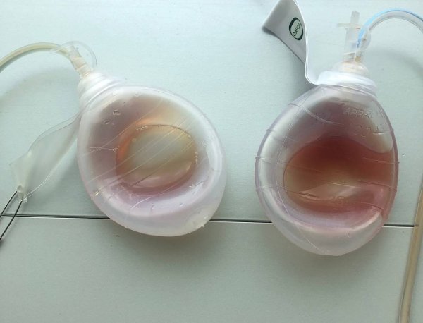  آیا گذاشتن و کشیدن درن درد دارد+درن چقدر در بدن می‌ماند+عمل لیفت سینه چگونه است+برای خوب شدن جای درن چه باید کرد