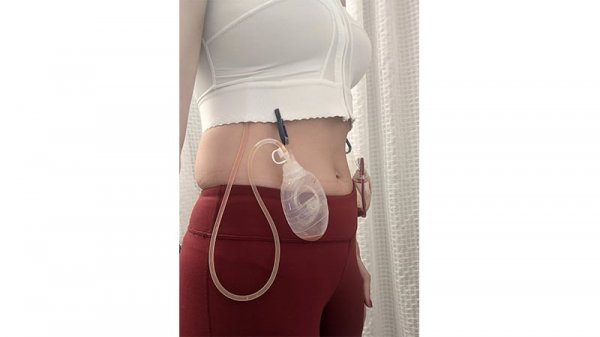  آیا گذاشتن و کشیدن درن درد دارد+درن چقدر در بدن می‌ماند+عمل لیفت سینه چگونه است+برای خوب شدن جای درن چه باید کرد