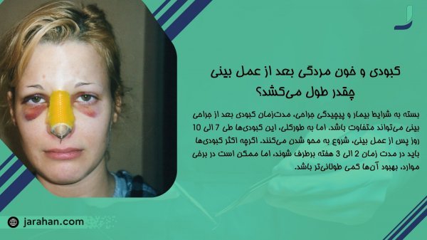 کبودی بعد از عمل بینی چقدر طول میکشد+آیا تزریق آنزیم بینی باعث نکروز می‌شود+آیا آب کرفس برای کبودی بعد از عمل بینی مفید است