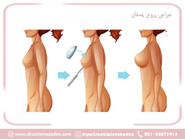  پروتز سينه چیست+جراحی پروتز سینه ارزان+قیمت پروتز سینه زنان+عوارض پروتز سینه زنان+سولاریوم و پروتز سینه