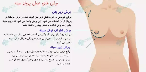 نظرات در مورد عمل پروتز سينه+سوتین طبی بعد از پروتزسینه+سوتین لیفت کننده چسبی+ماندگاری فیلر باسن+نظرات در مورد فیلر باسن