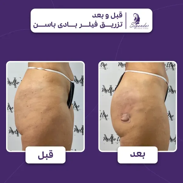  نظرات در مورد عمل پروتز سينه+سوتین طبی بعد از پروتزسینه+سوتین لیفت کننده چسبی+ماندگاری فیلر باسن+نظرات در مورد فیلر باسن