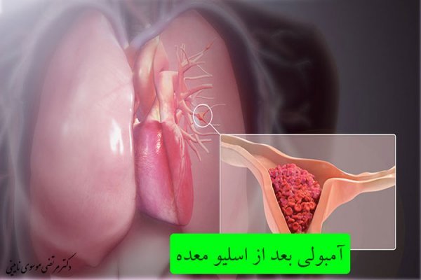  خطر آمبولی تا چند روز بعد از عمل اسلیو است