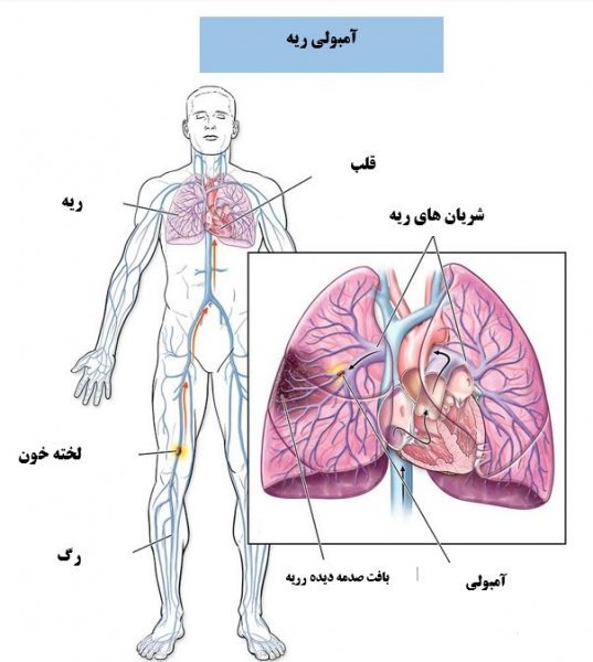  خطر آمبولی تا چند روز بعد از عمل اسلیو است