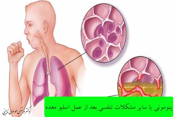  خطر آمبولی تا چند روز بعد از عمل اسلیو است