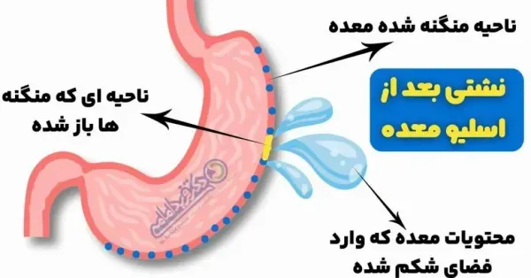  خطر آمبولی تا چند روز بعد از عمل اسلیو است