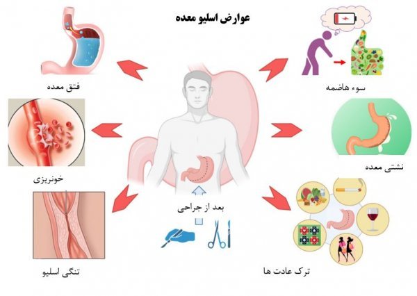  خطر آمبولی تا چند روز بعد از عمل اسلیو است