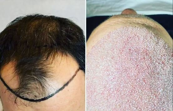 بهترین کلینیک کاشت مو در ایران+بهترین دکتر کاشت مو در تهران