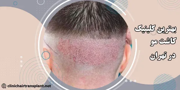  بهترین کلینیک کاشت مو در ایران+بهترین دکتر کاشت مو در تهران