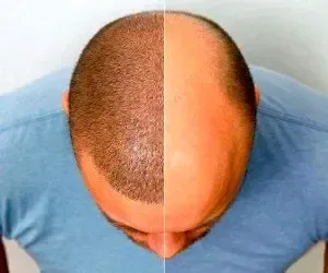  بهترین کلینیک کاشت مو در ایران+بهترین دکتر کاشت مو در تهران