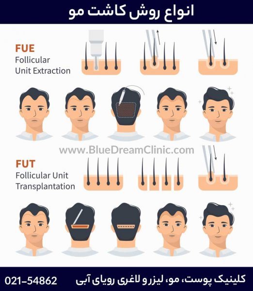  بهترین کلینیک کاشت مو در ایران+بهترین دکتر کاشت مو در تهران