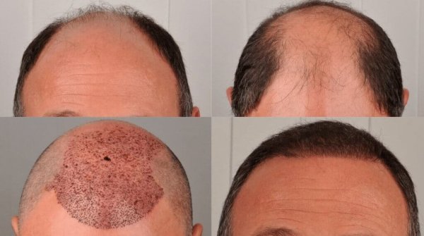  بهترین کلینیک کاشت مو در ایران+بهترین دکتر کاشت مو در تهران