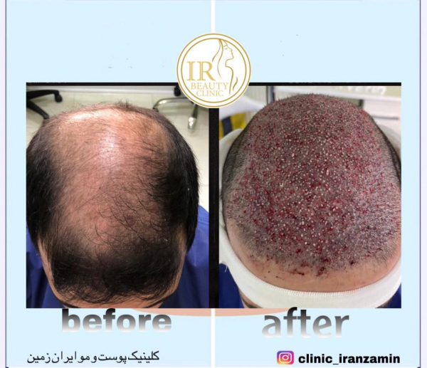  بهترین کلینیک کاشت مو در ایران+بهترین دکتر کاشت مو در تهران