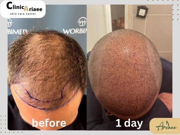  بهترین کلینیک کاشت مو در ایران+بهترین دکتر کاشت مو در تهران