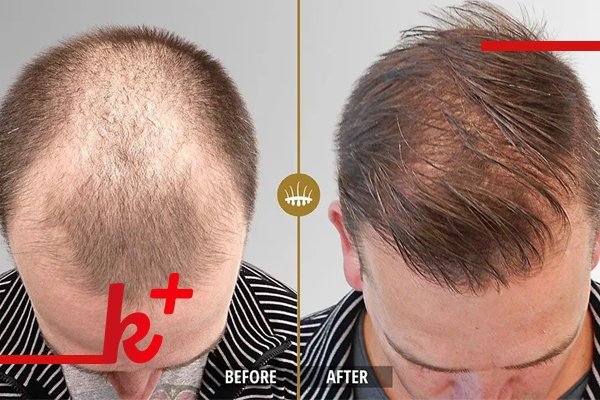  بهترین کلینیک کاشت مو در ایران+بهترین دکتر کاشت مو در تهران