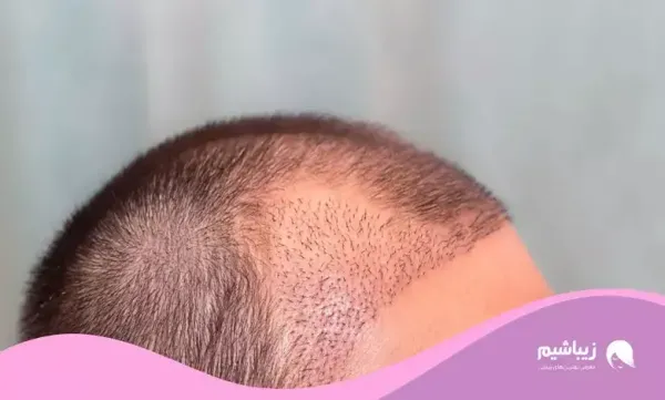  بهترین کلینیک کاشت مو در ایران+بهترین دکتر کاشت مو در تهران