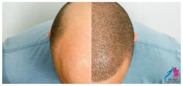  بهترین کلینیک کاشت مو در ایران+بهترین دکتر کاشت مو در تهران