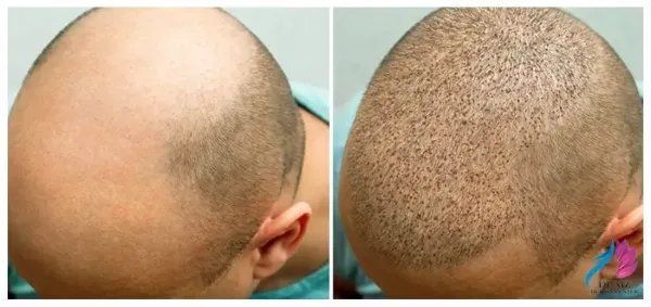  بهترین کلینیک کاشت مو در ایران+بهترین دکتر کاشت مو در تهران