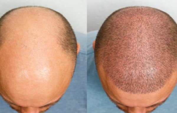  کاشت مو در کدام شهر بهتر است+کاشت مو در تهران بهتر است یا شیراز