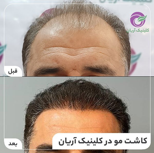  کاشت مو در کدام شهر بهتر است+کاشت مو در تهران بهتر است یا شیراز