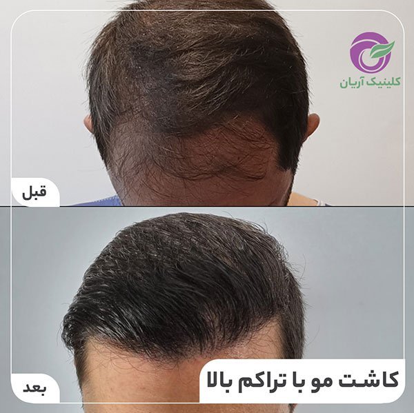  کاشت مو در کدام شهر بهتر است+کاشت مو در تهران بهتر است یا شیراز