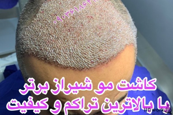  کاشت مو در کدام شهر بهتر است+کاشت مو در تهران بهتر است یا شیراز