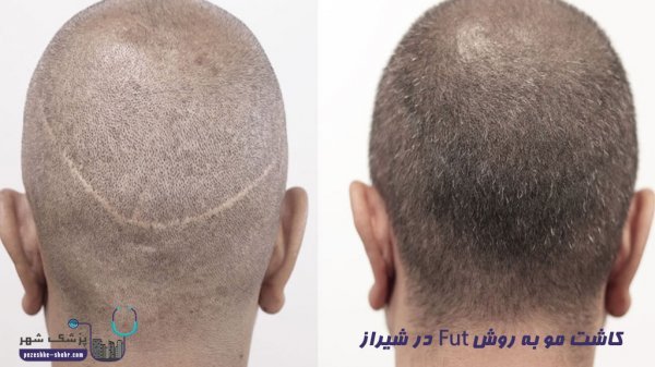  کاشت مو در کدام شهر بهتر است+کاشت مو در تهران بهتر است یا شیراز