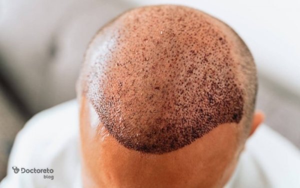  کاشت مو در کدام شهر بهتر است+کاشت مو در تهران بهتر است یا شیراز