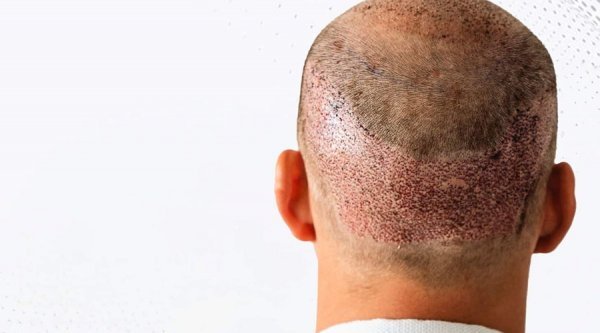  کاشت مو در کدام شهر بهتر است+کاشت مو در تهران بهتر است یا شیراز