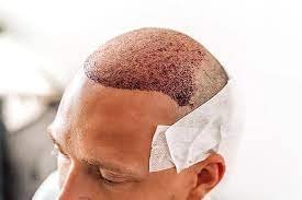  کاشت مو در کدام شهر بهتر است+کاشت مو در تهران بهتر است یا شیراز