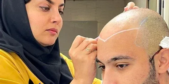  کاشت مو در کدام شهر بهتر است+کاشت مو در تهران بهتر است یا شیراز