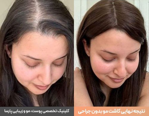 عکس های کاشت موی زنان + کاشت مو در زنان به چه صورت است