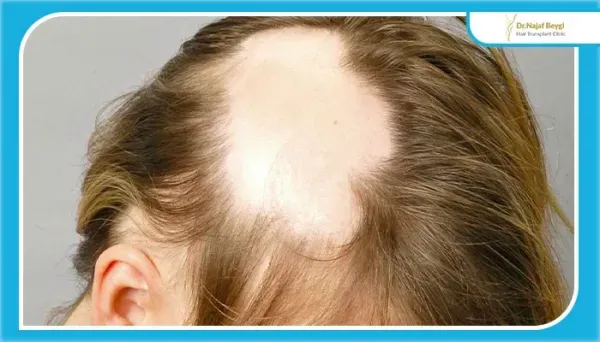  عکس های کاشت موی زنان + کاشت مو در زنان به چه صورت است