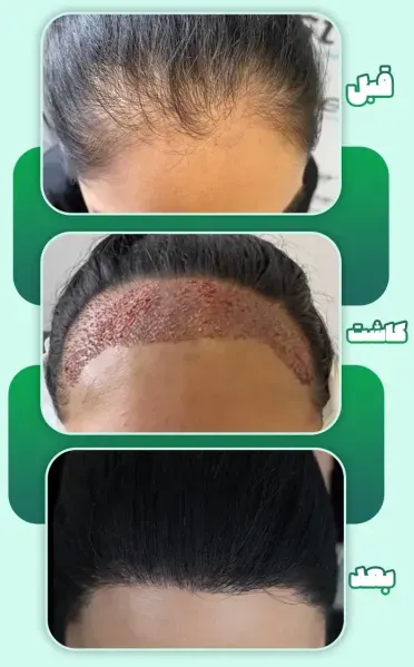  عکس های کاشت موی زنان + کاشت مو در زنان به چه صورت است