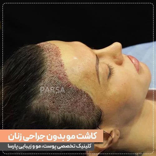  عکس های کاشت موی زنان + کاشت مو در زنان به چه صورت است