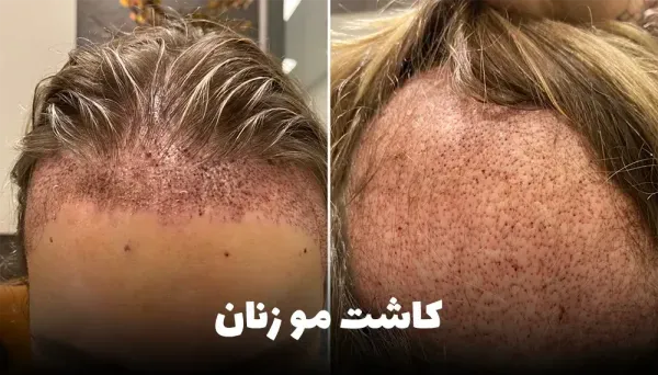  عکس های کاشت موی زنان + کاشت مو در زنان به چه صورت است