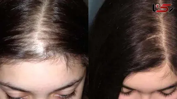  عکس های کاشت موی زنان + کاشت مو در زنان به چه صورت است