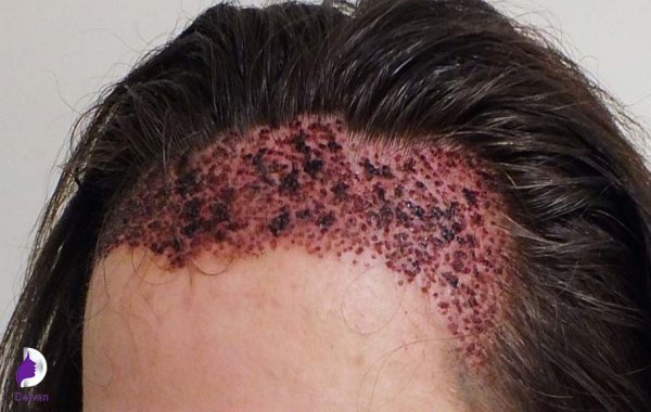  عکس های کاشت موی زنان + کاشت مو در زنان به چه صورت است